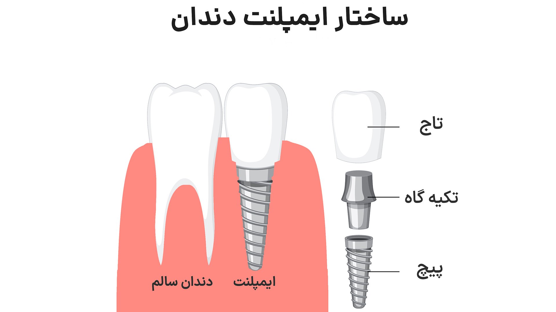 ساختار امپلنت دندانی