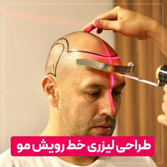 طراحی لیزری خط رویش مو